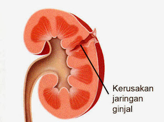 Ciri Ciri Sakit Radang Ginjal