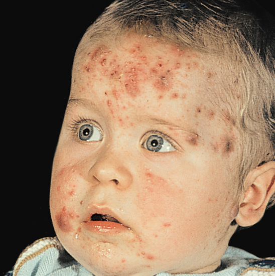 Baby Acne Causes Treatment and Prevention - BeautyHealthPlus