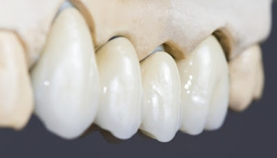 Cầu răng sứ sử dụng phổ biến hiện nay