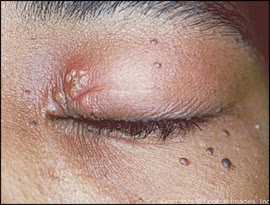Health And Weight Loss The Herpes Simplex Eyelid