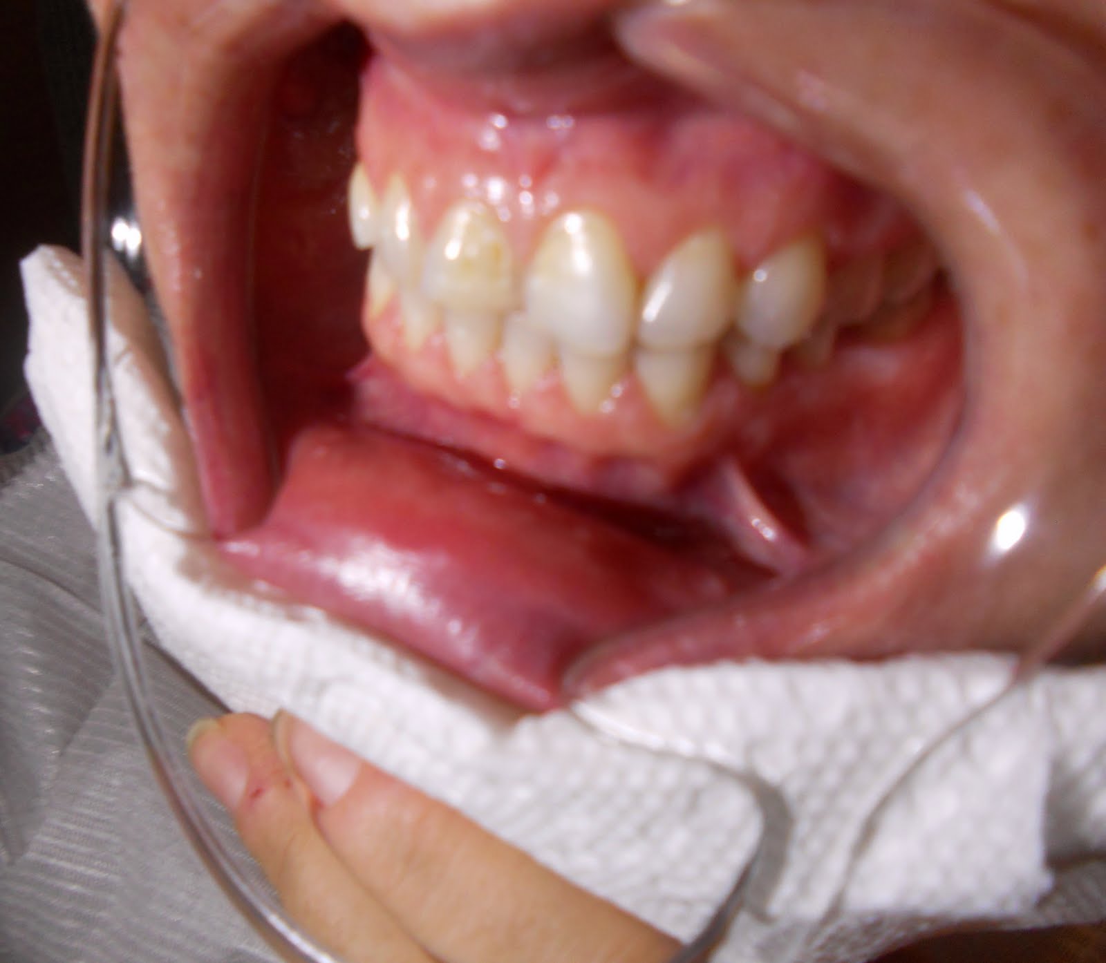 How do I get Whiter Teeth: Teeth Whitening - Testiomonials ...