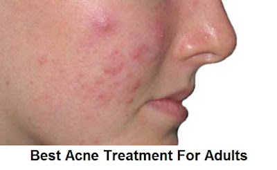 Causes And Treatment Of Acne In Adults