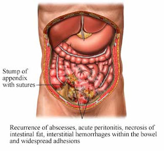 PERITONITIS : Komplikasi Nifas