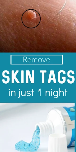 How to Remove Skin Tag in 1 Night