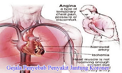 Gejala Penyakit Jantung