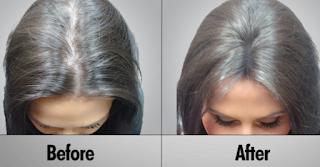 Laser Hair Growth before and after