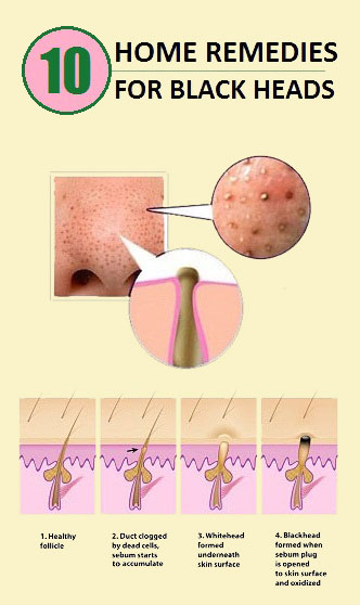 Top 10 Home Remedies for Blackheads