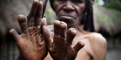 Tradisi Unik Potong Jari Tangan Ala Suku Dani Papua Indonesia