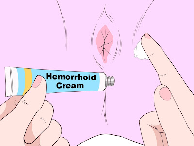How to Stop Hemorrhoids Bleeding