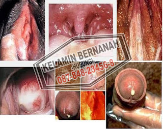 Seks Pada Remaja Dapat Memicu Kencing Nanah Gonorrhea