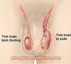 xoắn tinh hoàn