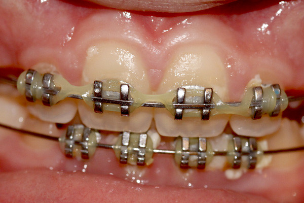 How Much Do Braces Hurt on a Scale 1-10 | Do Braces Hurt?