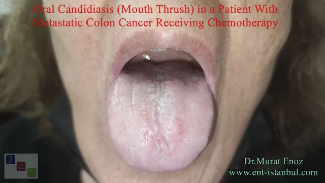 Candida infection of soft palate,Oral thrush,Yeast infection in mouth,Mouth thrush,Oral candidiasis,