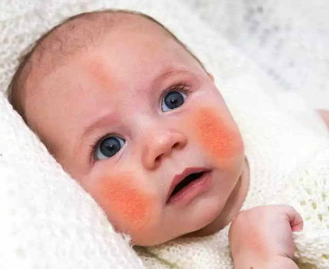 How does the baby eczema look like