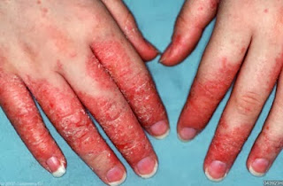 eksim/dermatitis