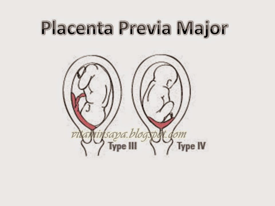 Plasenta Previa: Komplikasi Kehamilan Yang Wajib Anda ...