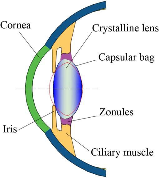 Intraocular lens (IOL)