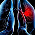 Lung cancer