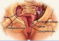 Penyebab Dan Tanda Penyakit Endometriosis