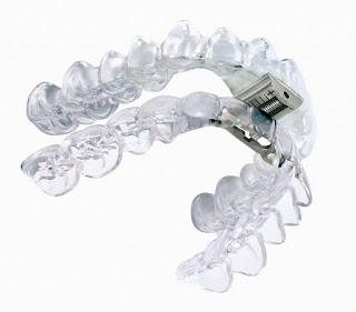 Niềng răng Invisalign và Clear Aligner có gì khác?