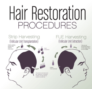 Hair transplant in Indore, Hair transplant cost in Indore, Hair doctor in Indore, Hair treatment in Indore