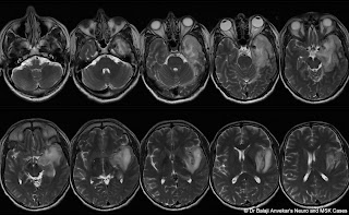 TUMOR%2BMIMICS.jpg