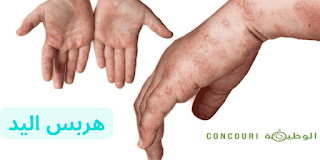 هربس اليد: الأسباب، الأعراض، التشخيص وخيارات العلاج التفصيلية