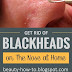 How to get rid of blackheads on the nose
