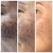 Get Rid of Dark Spots and Age Spots on Face