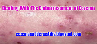 Dealing With The Embarrassment of Eczema