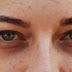 What Causes the Dark circles : Dark Circle removal tips