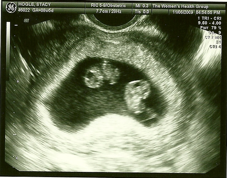 ... (19) Gallery Images For Identical Vs Fraternal Twins Ultrasound