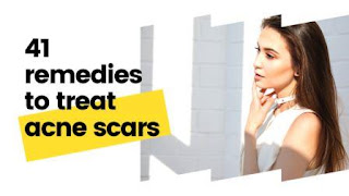 41 Remedies to treat acne scars