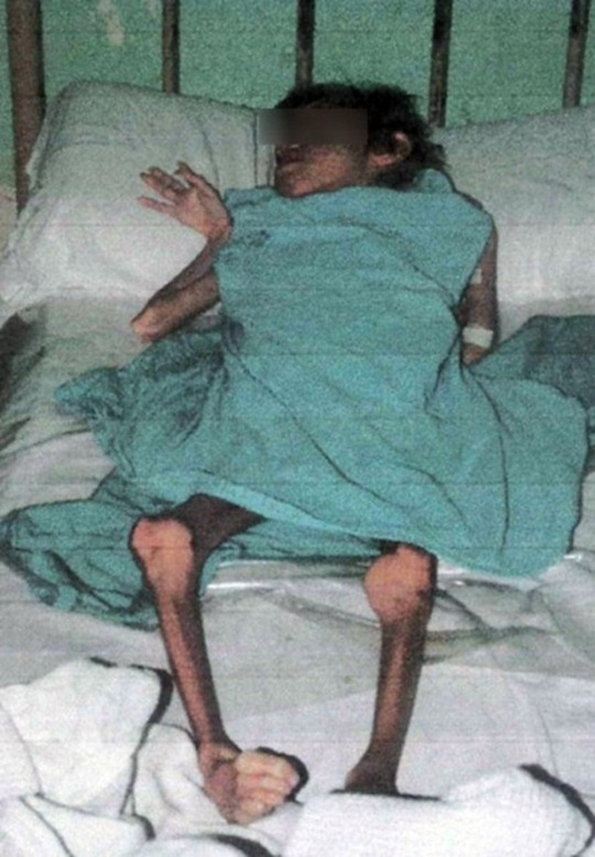 Jóven con desnutricion extrema e irreversible en Corrientes