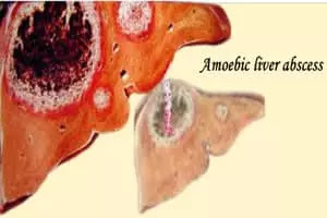 amoebic liver abscess