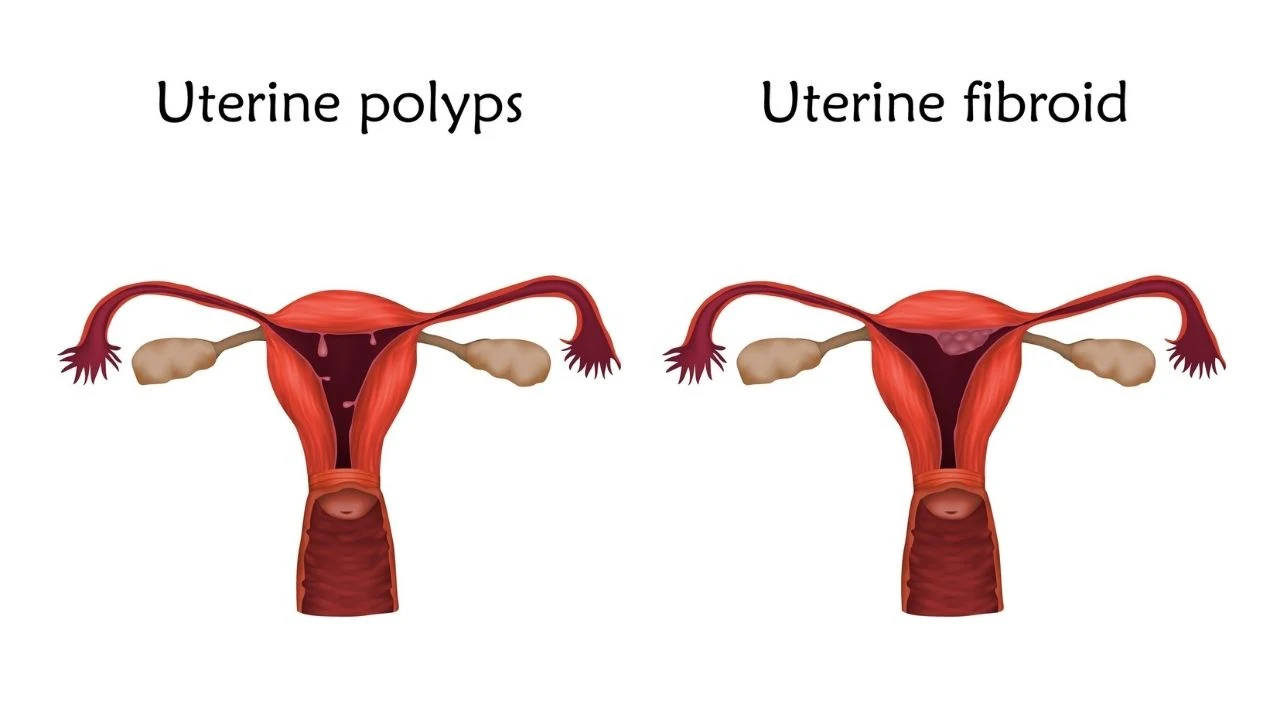 A medical illustration depicting uterine fibroids.