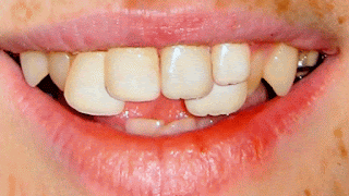 Cara Meratakan Gigi  Anda Tanpa Kawat Gigi  ARTIQEL