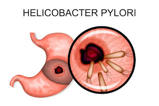 O tratamento natural do H. pylori pode incluir probióticos, suplementos fitoterápicos e suplementos vitamínicos.