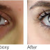 Treatment of Dark Circles Under the Eyes