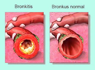 Obat Bronkitis Untuk Anak