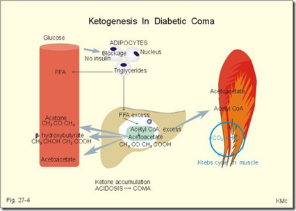 ketoacidosis glycogenolysis School  Mellitus Trusted Notes Lecture Diabetes Medical â€“  (X)