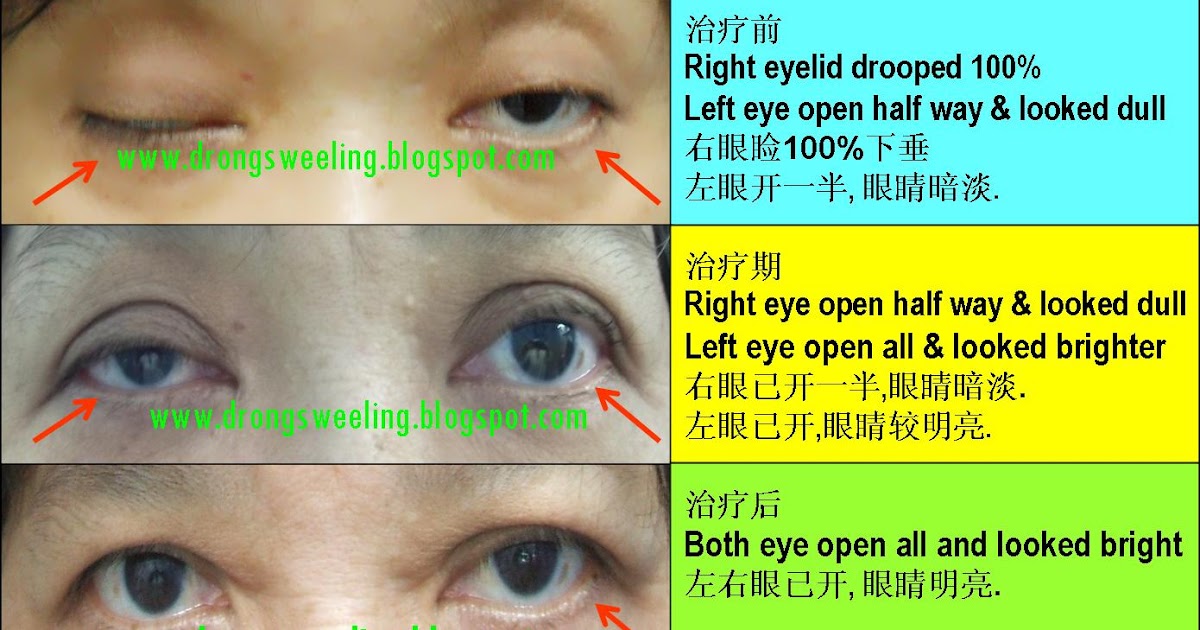 Download TCM News: Acupuncture Cure Drooping Eyelids 眼睑下垂