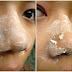 Black Heads Removal Mask - Tips & Tutorial