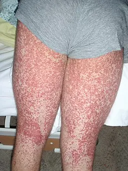 HSP rash in children