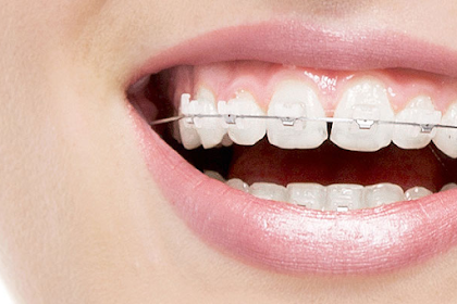 How To Find An Invisalign Dentist