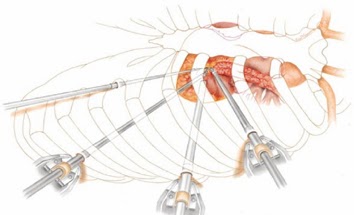 Minimally Invasive Spine Surgery Cost