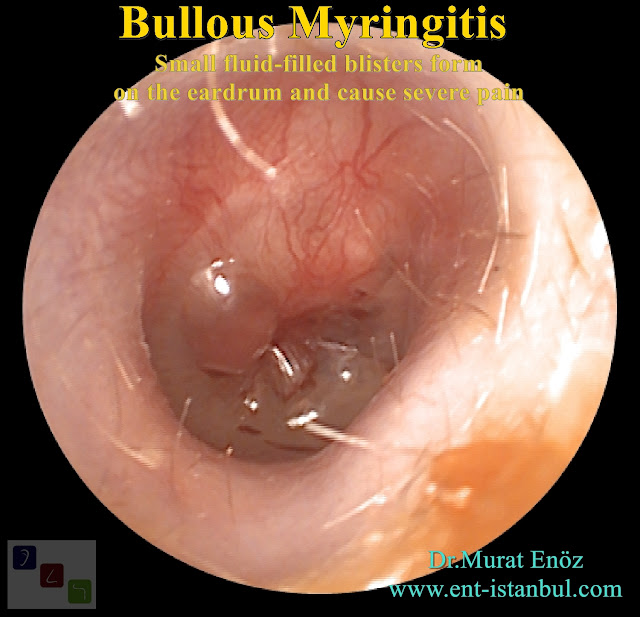 Bullous Myringitis