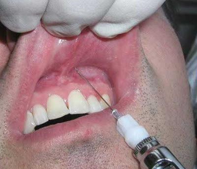 Thuốc gây tê răng và những điều bạn chưa biết