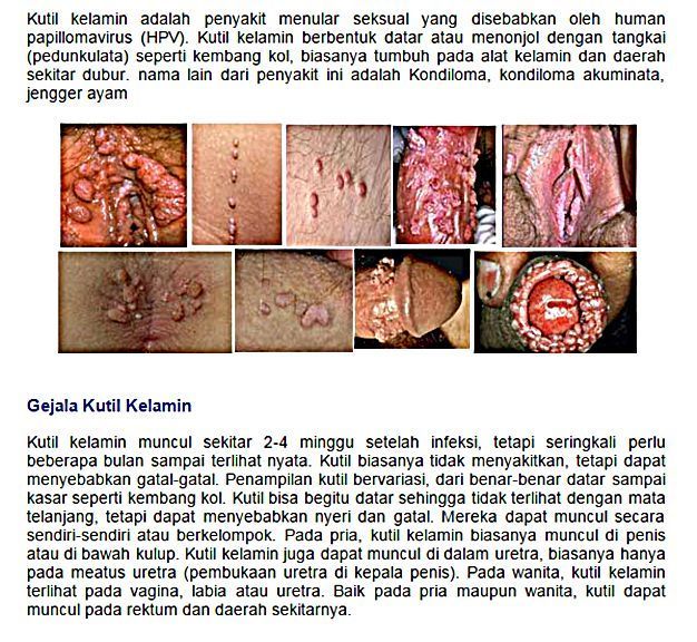 Obat Kutil Kelamin Di Dumadama,Pengobatan Kutil Kelamin Di Curugbitung,Obat Kutil Kemaluan Di Ngrambe,Obat Herbal Kutil Kelamin Di Samofa,Obat Kutil Kelamin Denature Di Mandrehe,Obat Tradisional Kutil Di Kelamin