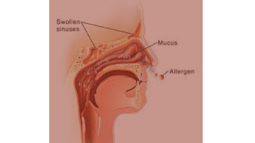 Untitled%20designnasal%20allergy%20w